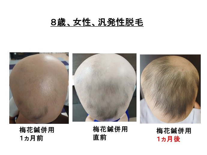 円形脱毛症　病院